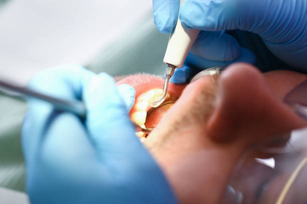 Best Broken or Chipped Tooth Repair in Labasas, CA